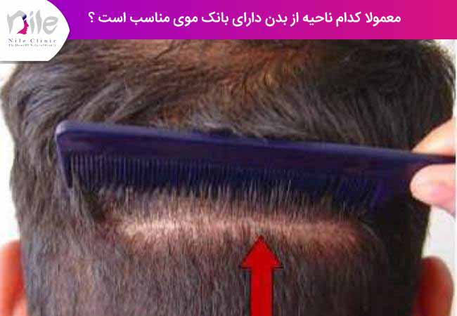 معمولا کدام ناحیه از بدن دارای بانک موی مناسب است ؟