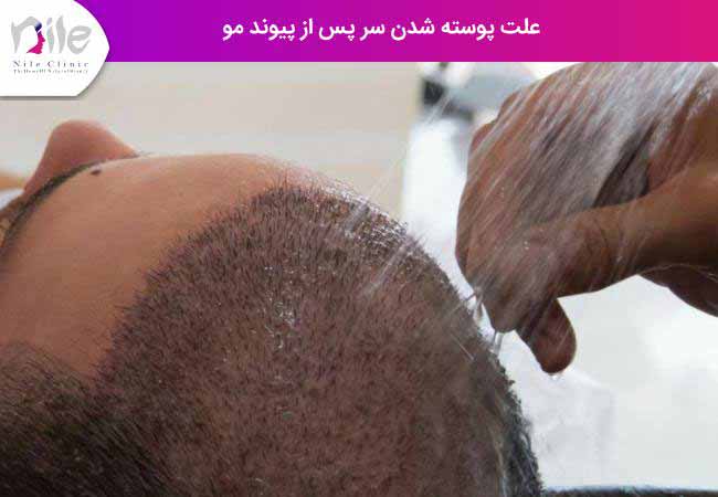 علت پوسته شدن سر پس از پیوند مو