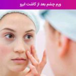 ورم چشم بعد از کاشت ابرو