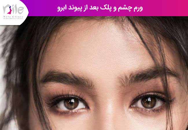 ورم چشم و پلک بعد از پیوند ابرو