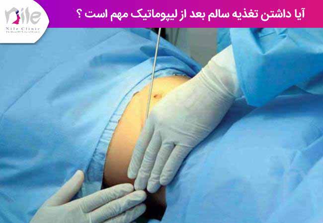 آیا داشتن تغذیه سالم بعد از لیپوماتیک مهم است ؟