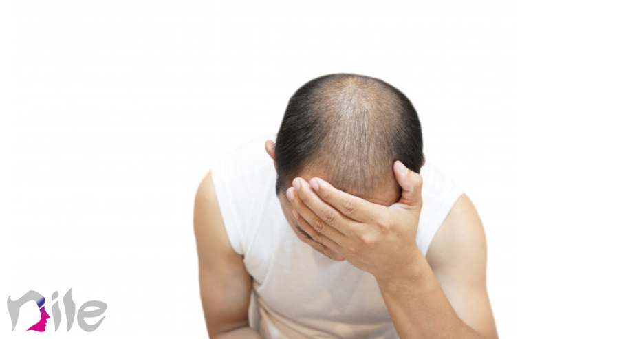 شامپو پس از کاشت مو