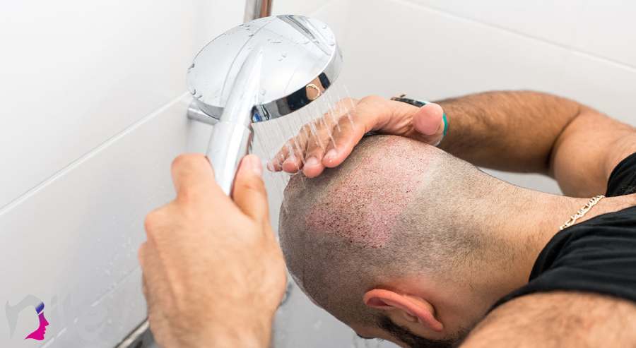 شستشو سر بعد از کاشت مو
