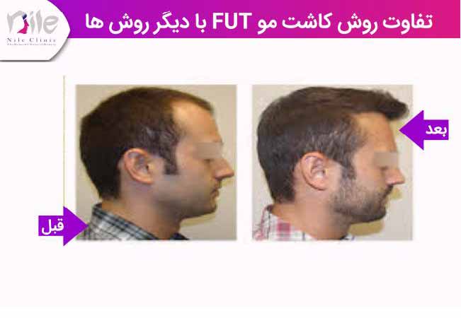 کاشت مو به روش FUTو تفاوت با سایر روش ها