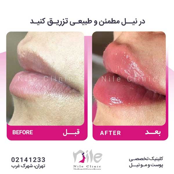 تزریق ژل