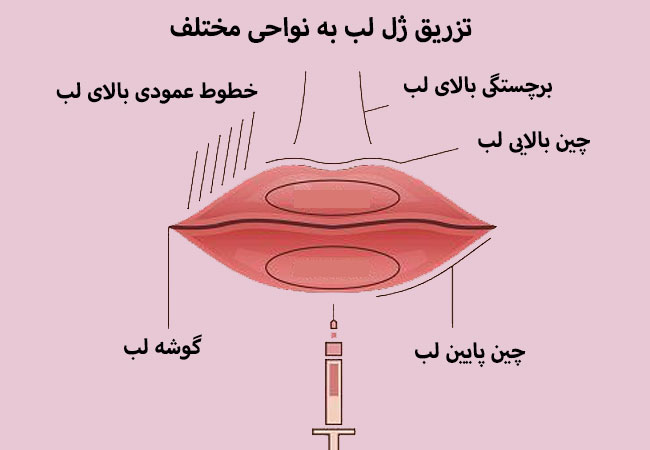 تزریق ژل لب به نواحی مختلف