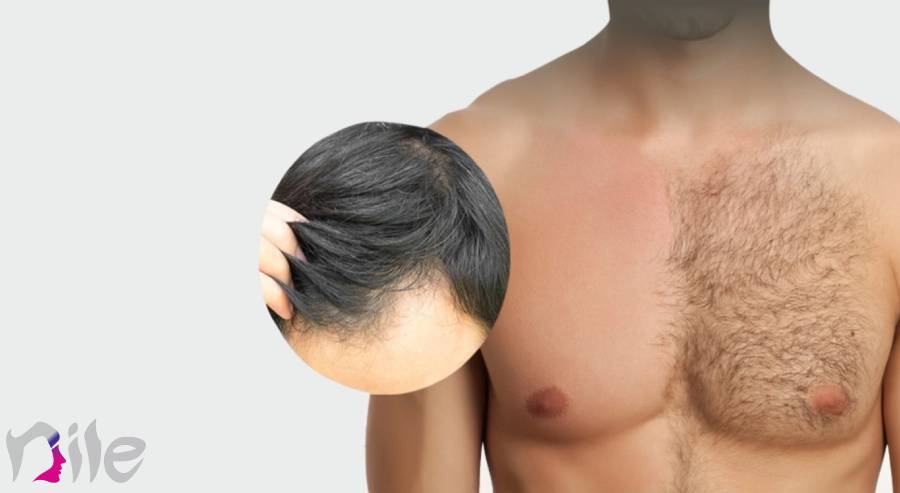 بهترین کاندیدها برای روش کاشت مو bht