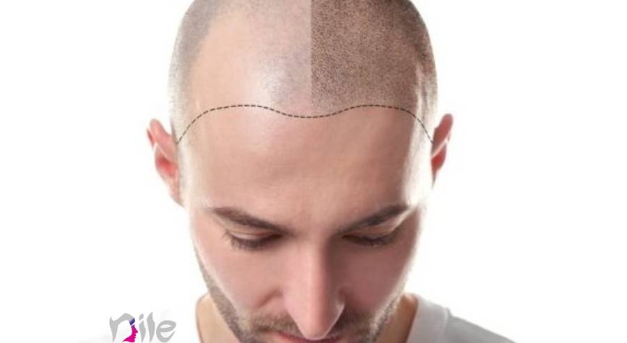 کاشت مو به روش fue، مراحل کاشت و هزینه