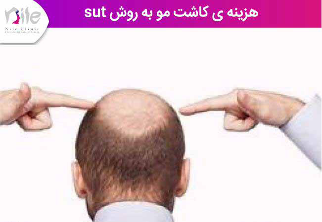 قیمت روش کاشت مو sut