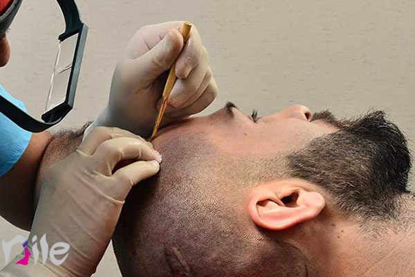طریقه جلوگیری از ایجاد عفونت بعد کاشتن مو