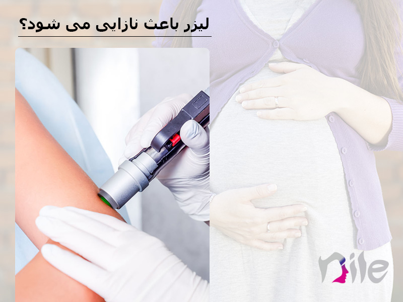لیزر و نازایی