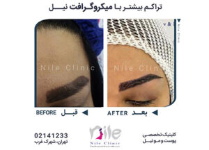 عکس قبل و بعد کاشت ابرو
