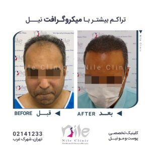 نمونه کاشت مو میکروگرافت
