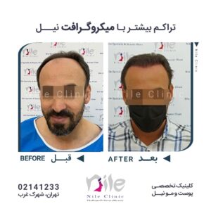 کاشت مو به روش طبیعی