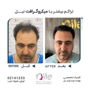 کاشت مو با تراکم بیشتر