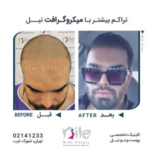 نمونه عالی کاشت مو