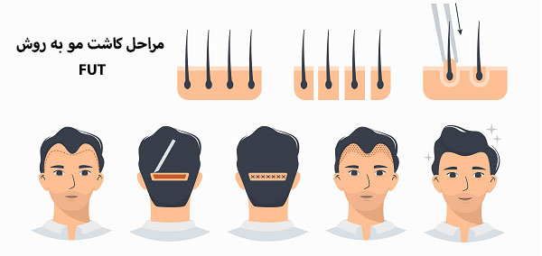 مراحل کاشت مو به روش FUT