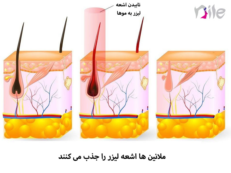 طریقه انجام لیزر موهای زائد