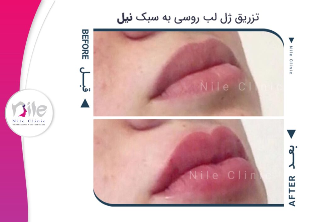 تزریق ژل لب مدل روسی
