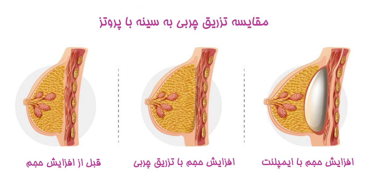 مقایسه تزریق چربی به سینه با پروتز